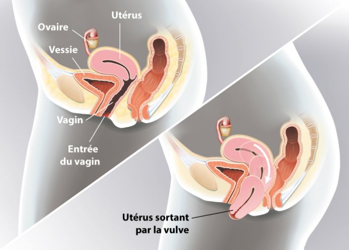post-partum-descente-organes